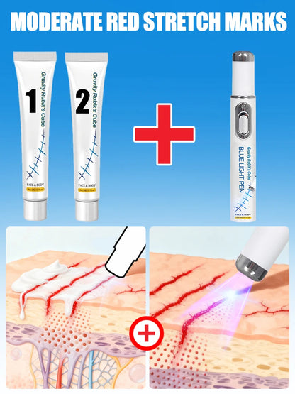 Striae blue light tool Goodbye To Stretch Marks, Maternal Skincare Tools - Global Mix