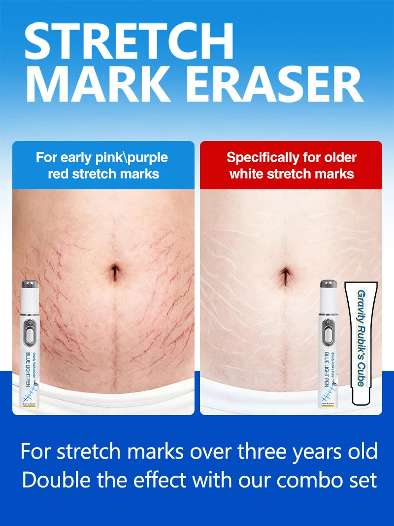 Striae blue light tool Goodbye To Stretch Marks, Maternal Skincare Tools - Global Mix