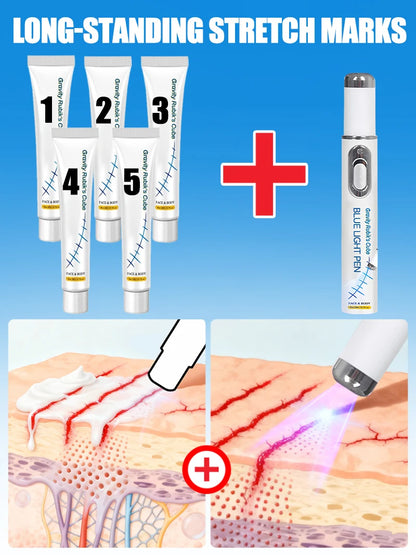 Striae blue light tool Goodbye To Stretch Marks, Maternal Skincare Tools - Global Mix