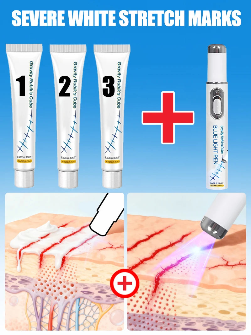 Striae blue light tool Goodbye To Stretch Marks, Maternal Skincare Tools - Global Mix