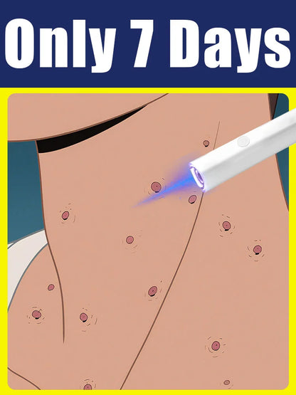 Blue light pen solve warts, hot sale wart care tools - Global Mix