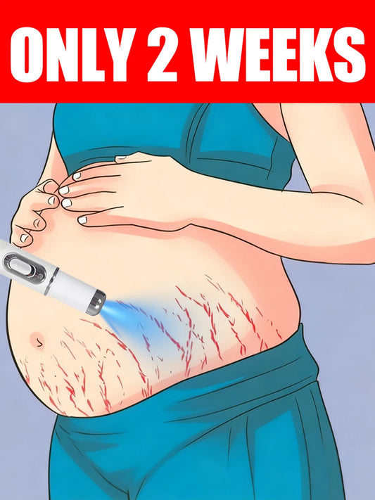Striae blue light tool Goodbye To Stretch Marks, Maternal Skincare Tools - Global Mix